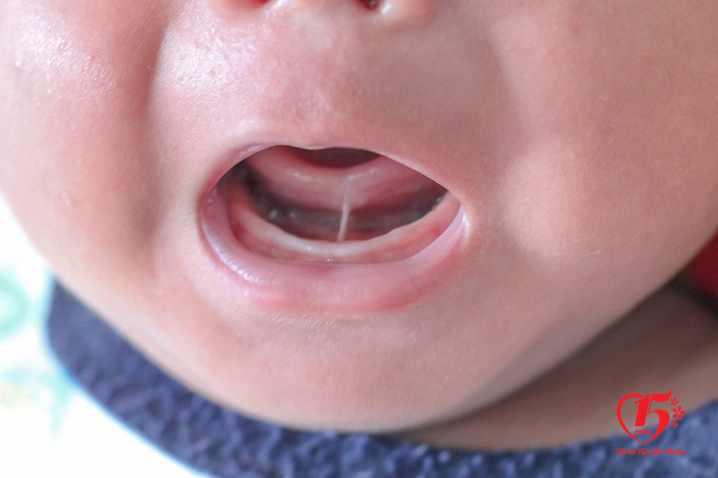Dính thắng lưỡi khiến trẻ gặp khó khi bú, phát hiện trễ gây chậm nói.